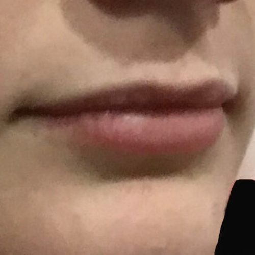 Lips Fillers, before, Lexinic.jpg