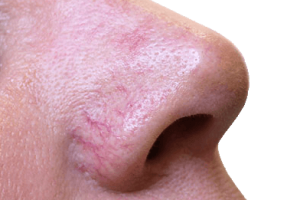 Laser red vein removal, Lexinic.jpg