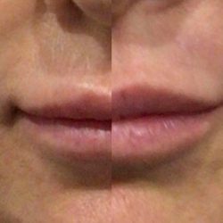 Dermal fillers, LEXINIC.jpg