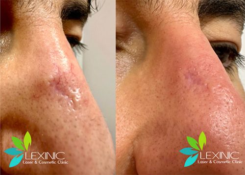 Before/After facial vein treatment, Lexinic Clinic.jpg