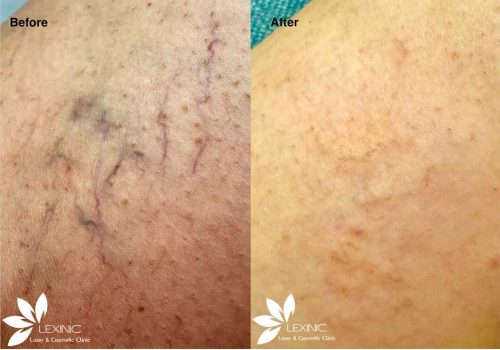 Before/After Laser red vein removal, Lexinic Clinic.png